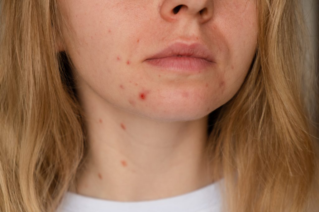 DIU hormonal pode levar a um ligeiro aumento da acne